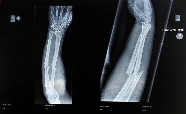 An X-ray of Steve Plater's injured arm (Honda Racing)